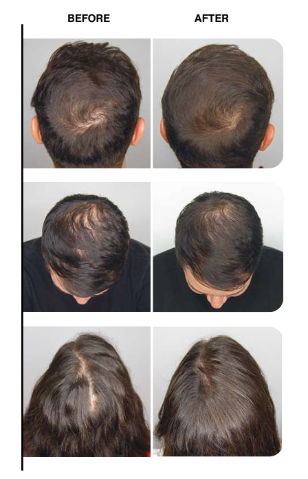 Before and after images of hair growth with SEYTU fortifying hair lotion